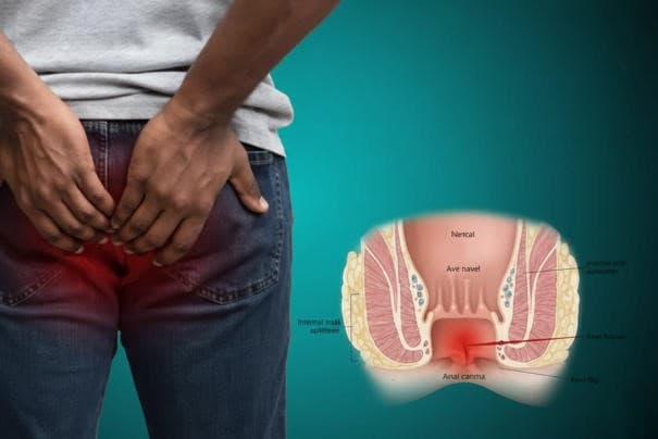 Anal Fissure Treatment in Delhi - Expert laser surgery treatment in Delhi, India by Dr. Kapil Agrawal